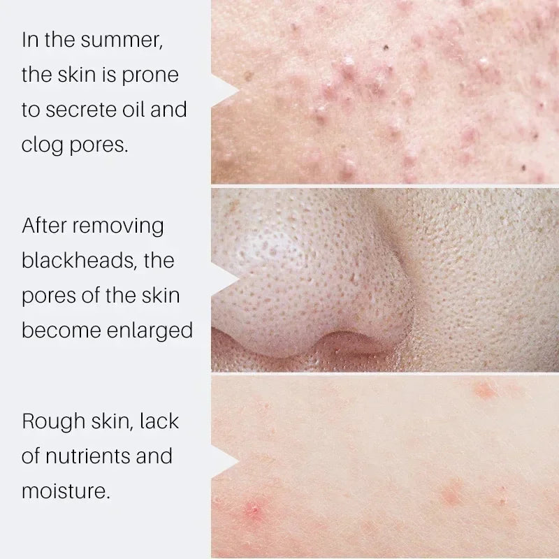 Salicylic Acid Pore Shrinking Cream Eliminate Large Pores Serum Remove Blackhead Acne Repairing Tightening Skin Care Cosmetics