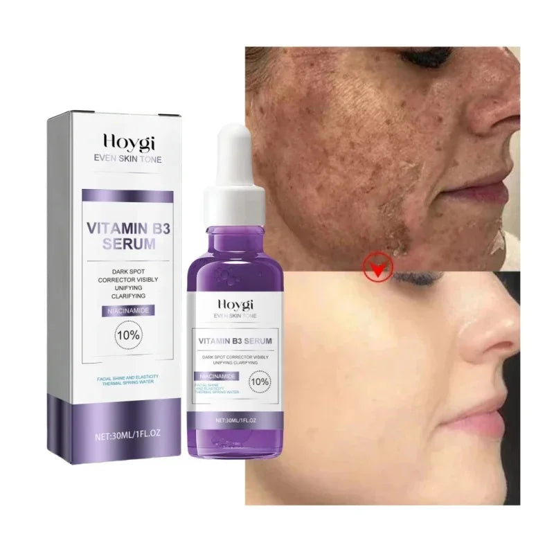 Dark Spots Remover Whitening Serum Face Freckle Melanin Correcting Anti Pigmentation Brighten Beauty Korean Day Night Skin Care 1PC