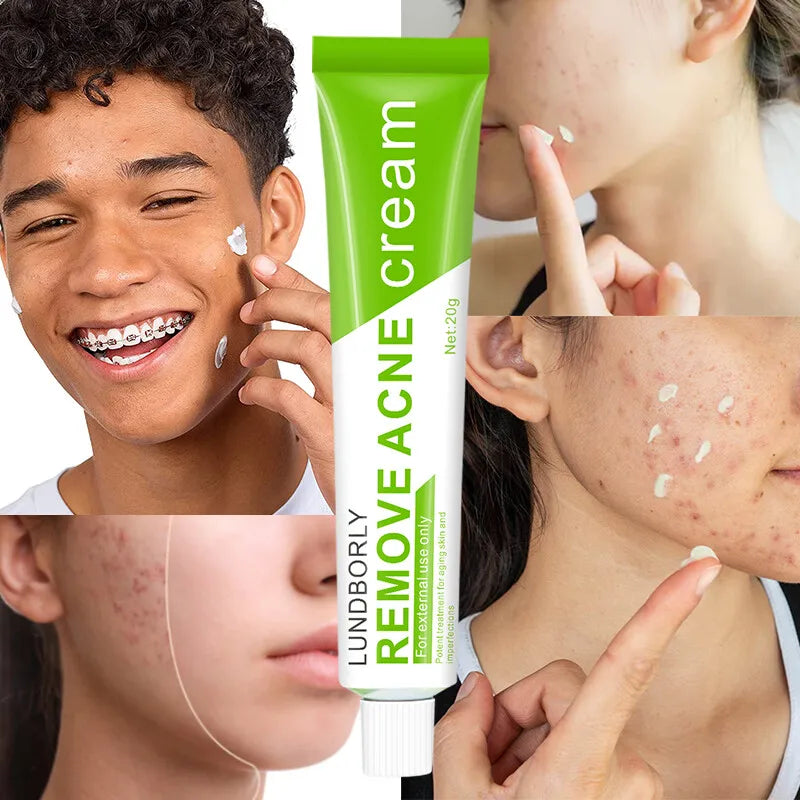 Natural Herbal Face Cream 20g Acne Cream with Salicylic Acid Oil Control Moisturizing Fading Acne Marks Gentle Non Irritating