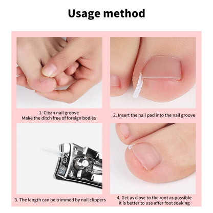 50Pcs Ingrown Toenail Correction Tool Ingrown Toe Nail Treatment Elastic Patch Sticker Straightening Clip Brace Pedicure Tool
